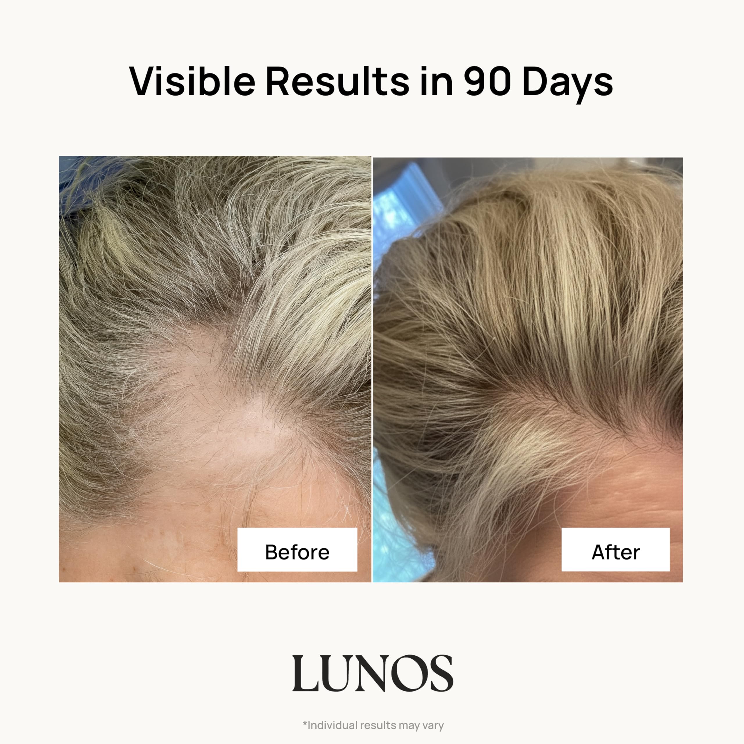 Hair Growth Vitamins Biotin Collagen Saw Palmetto